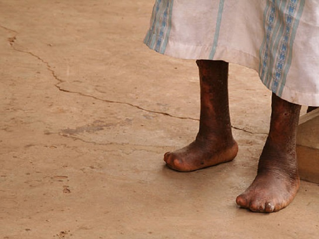 7 Signs You May Have Leprosy -- Symptoms, Causes, Effects, Treatment and Prevention