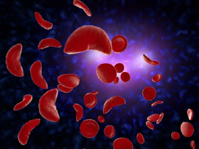 7 Signs You May Have Sickle cell anemia -- Symptoms, Causes, Effects, Treatment and Prevention