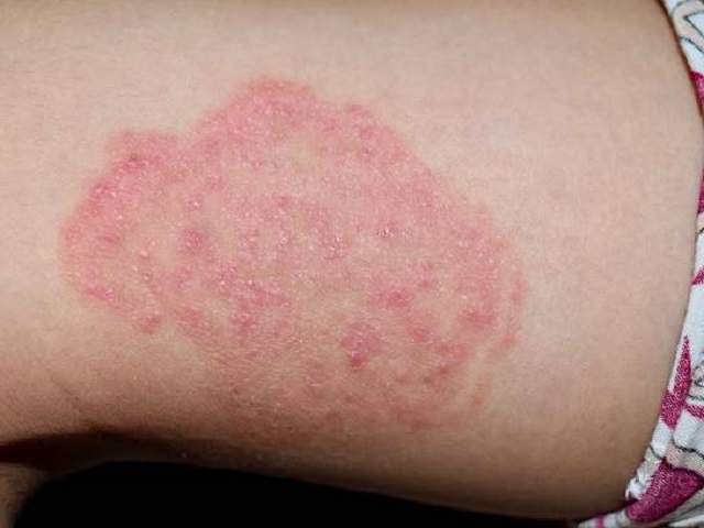 4 Signs You May Have Ringworm -- Symptoms, Causes, Effects, Treatment and Prevention