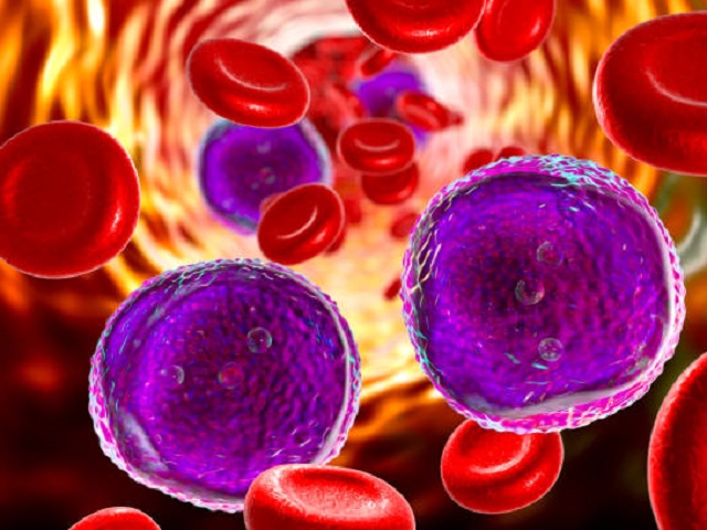 10 Signs You May Have Leukemia -- Symptoms, Causes, Effects, Treatment and Prevention