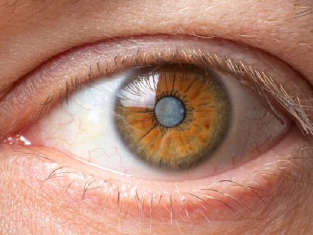 6 Signs You May Have Glaucoma -- Symptoms, Causes, Effects, Treatment and Prevention