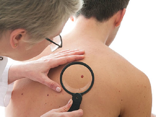 6 Signs You May Have Melanoma -- Symptoms, Causes, Effects, Treatment and Prevention