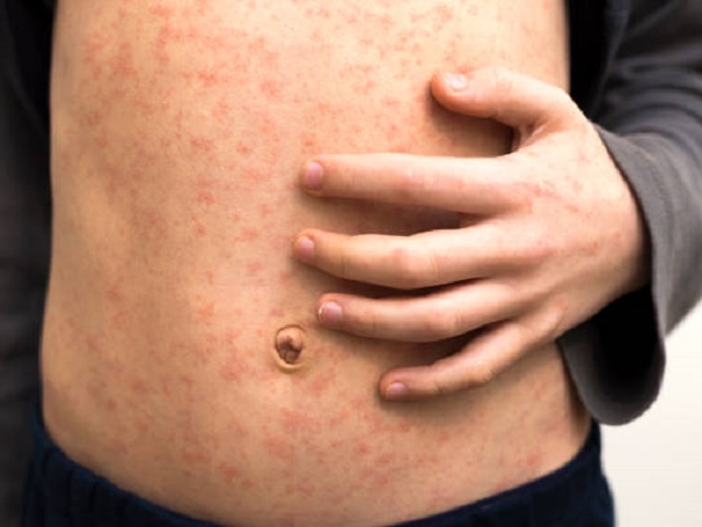 8 Signs that You May Have Measles -- Symptoms, Causes, Effects, Treatment and Prevention