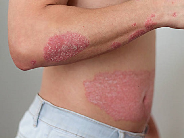 6 Signs You May Have Psoriasis -- Symptoms, Causes, Effects, Treatment and Prevention