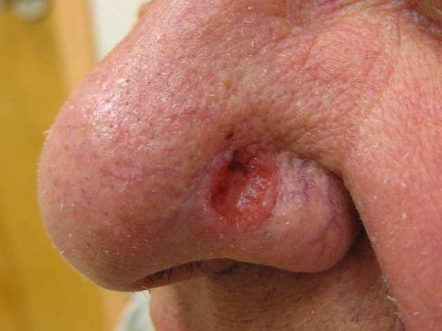 4 Signs You May Have Basal Cell Carcinoma -- Symptoms, Causes, Effects, Treatment and Prevention