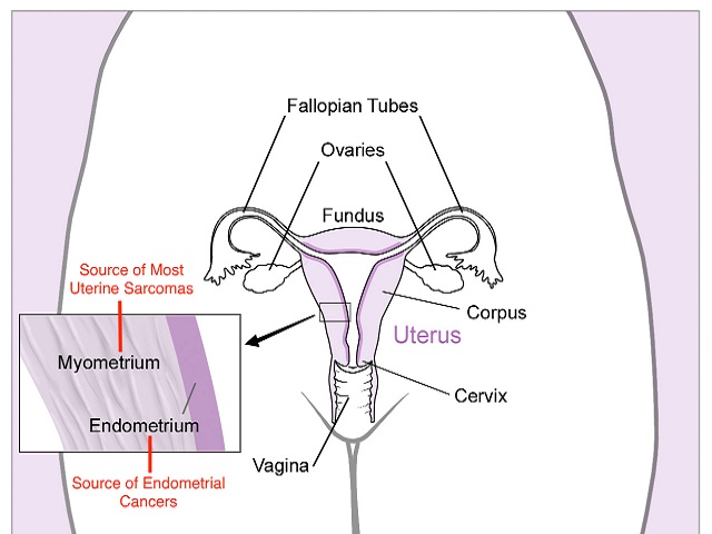 4 Signs You May Have Uterine Cancer -- Symptoms, Causes, Effects, Treatment and Prevention