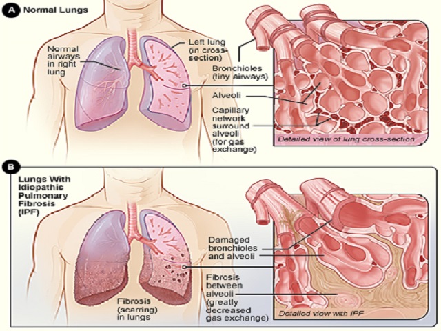 5 Signs You May Have Idiopathic Pulmonary Fibrosis -- Symptoms, Causes, Effects, Treatment and Prevention