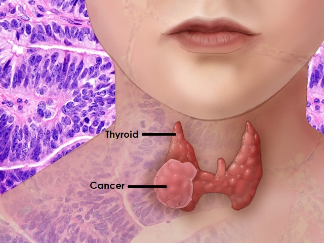 5 Signs You May Have Thyroid Cancer -- Symptoms, Causes, Effects, Treatment and Prevention