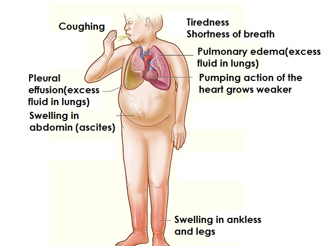 9 Signs You May Have Congestive Heart Failure -- Symptoms, Causes, Effects, Treatment and Prevention