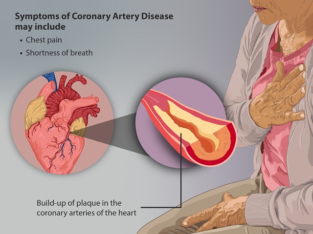 5 Signs You May Have Coronary Artery Disease -- Symptoms, Causes, Effects, Treatment and Prevention