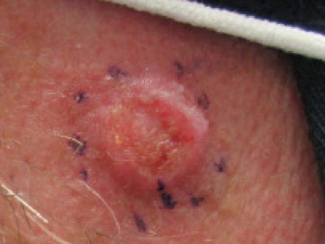 5 Signs You May Have Squamous Cell Carcinoma -- Symptoms, Causes, Effects, Treatment and Prevention